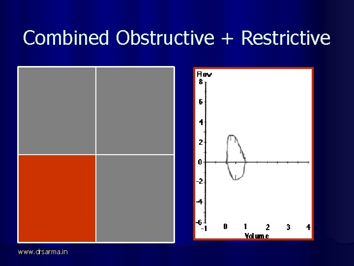 Combined Obstructive + Restrictive FEV 1 is LOW FVC is Normal FEV 1 ÷