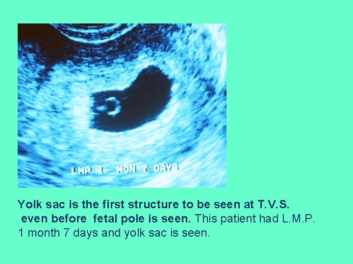 Yolk sac is the first structure to be seen at T. V. S. even
