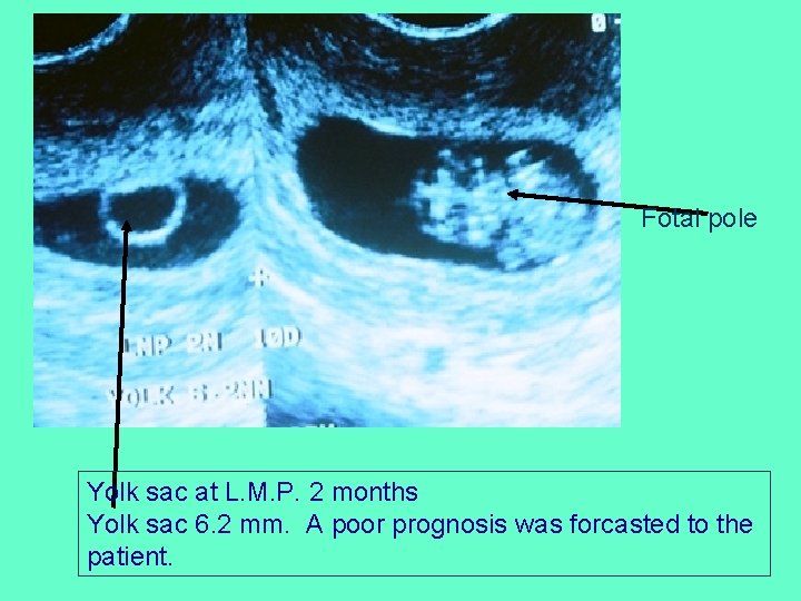 Fotal pole Yolk sac at L. M. P. 2 months Yolk sac 6. 2