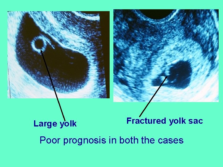 Predictive Value of Yolk Sac in Early Pregnancy