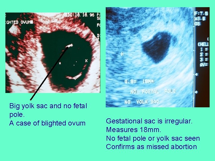 Big yolk sac and no fetal pole. A case of blighted ovum Gestational sac