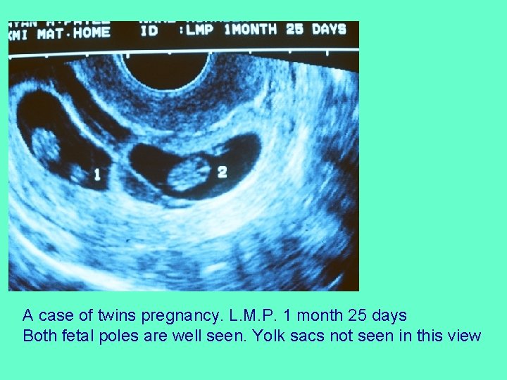 A case of twins pregnancy. L. M. P. 1 month 25 days Both fetal