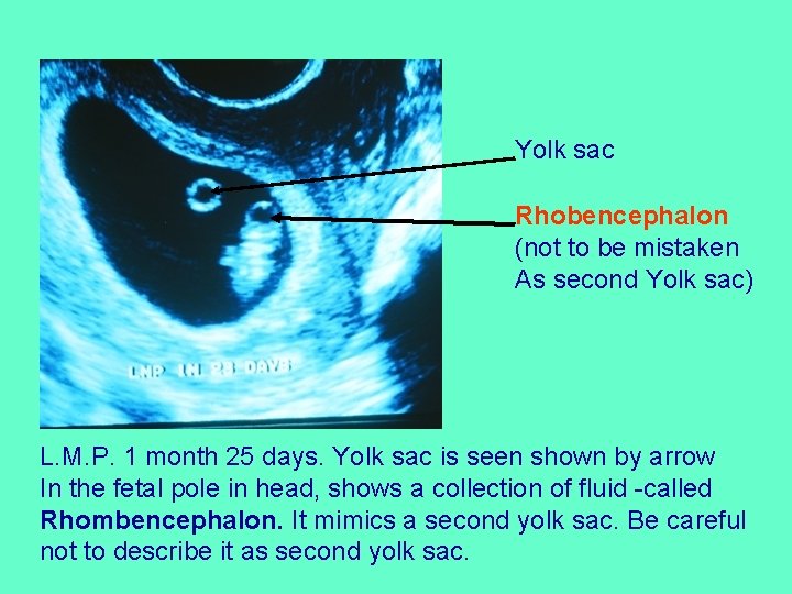 Yolk sac Rhobencephalon (not to be mistaken As second Yolk sac) L. M. P.