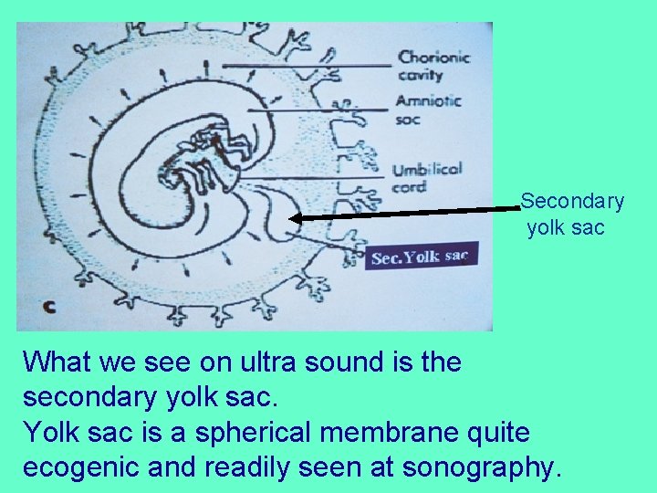 Secondary yolk sac What we see on ultra sound is the secondary yolk sac.