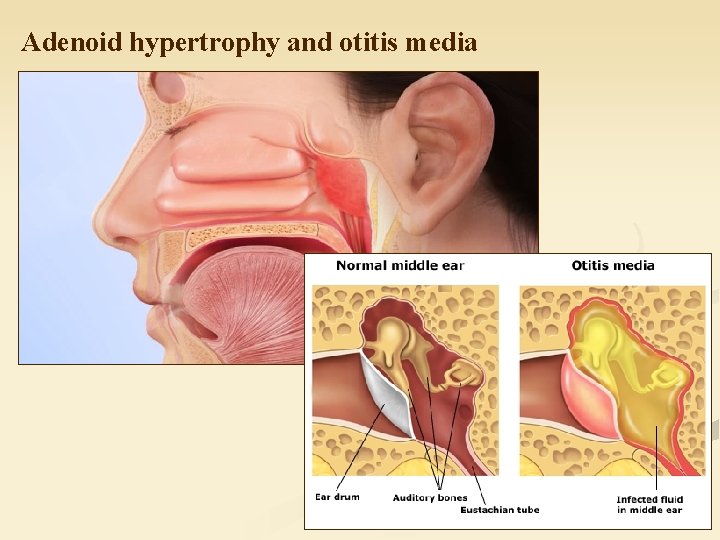 Adenoid hypertrophy and otitis media 