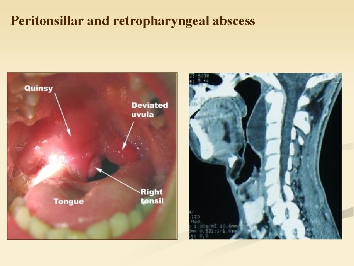 Peritonsillar and retropharyngeal abscess 