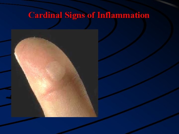 Cardinal Signs of Inflammation 