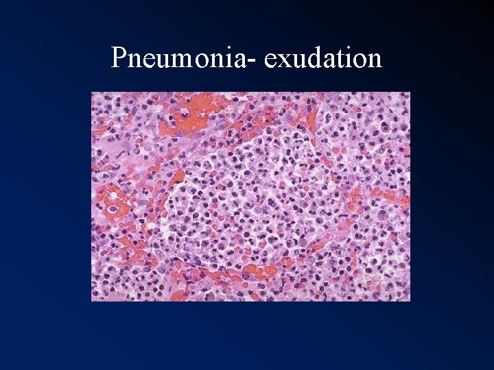 Pneumonia- exudation 