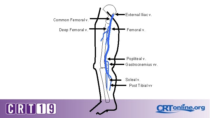 External Iliac v. Common Femoral v. Deep Femoral v. Popliteal v. Gastrocnemius vv. Soleal