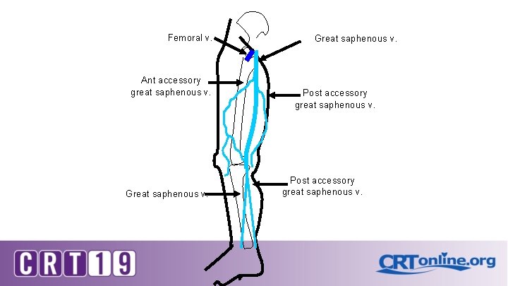 Femoral v. Ant accessory great saphenous v. Great saphenous v. Post accessory great saphenous