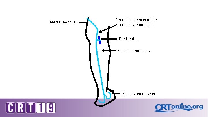 Intersaphenous v. Cranial extension of the small saphenous v. Popliteal v. Small saphenous v.