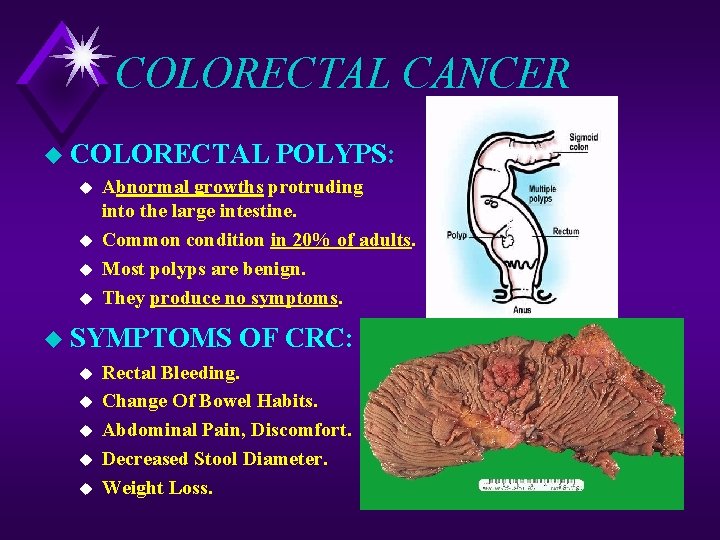 COLORECTAL CANCER u COLORECTAL u u Abnormal growths protruding into the large intestine. Common