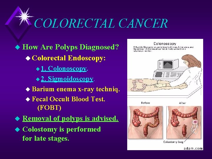 COLORECTAL CANCER u How Are Polyps Diagnosed? u Colorectal Endoscopy: u 1. Colonoscopy. u