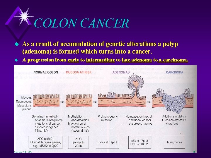COLON CANCER u As a result of accumulation of genetic alterations a polyp (adenoma)