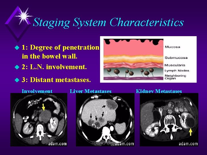 Staging System Characteristics 1: Degree of penetration in the bowel wall. u 2: L.
