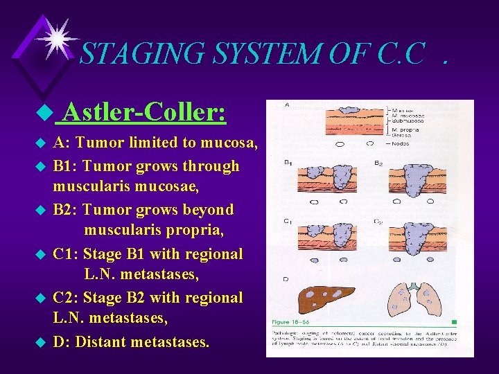STAGING SYSTEM OF C. C. u u u u Astler-Coller: A: Tumor limited to