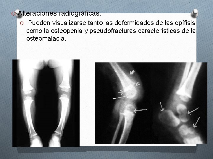 O Alteraciones radiográficas. O Pueden visualizarse tanto las deformidades de las epífisis como la