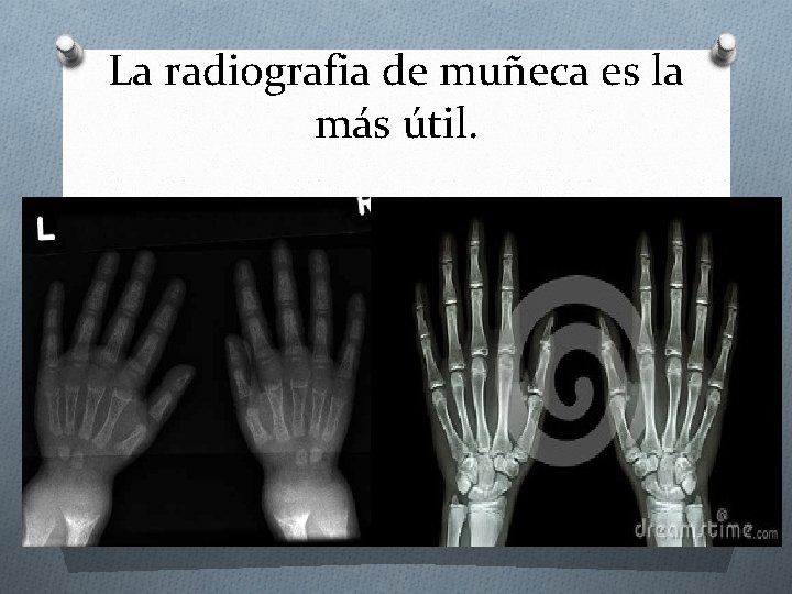 La radiografia de muñeca es la más útil. 