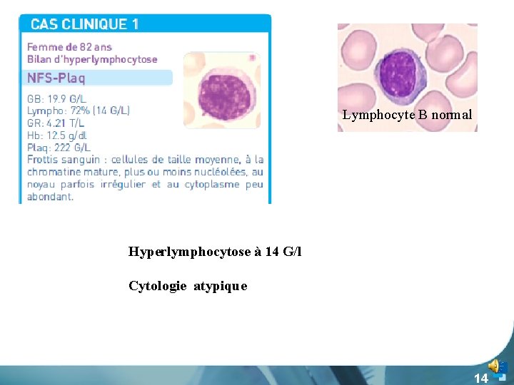 Lymphocyte B normal Hyperlymphocytose à 14 G/l Cytologie atypique 14 
