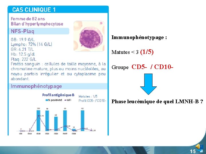 Immunophénotypage : Matutes < 3 (1/5) Groupe CD 5 - / CD 10 -