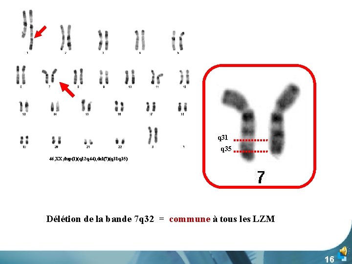 3 q 31 q 35 46, XX, dup(1)(q 12 q 44), del(7)(q 31 q