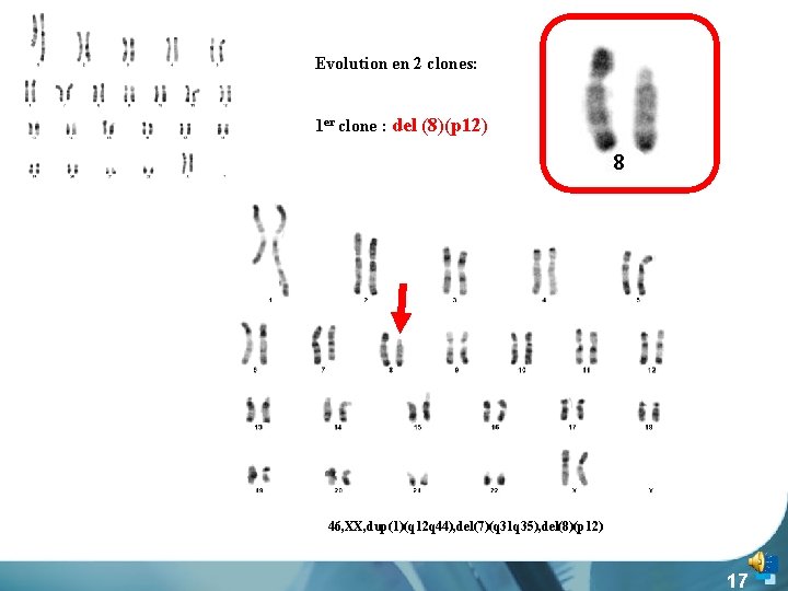 Evolution en 2 clones: 1 er clone : del (8)(p 12) 4646, XX, dup(1)(q