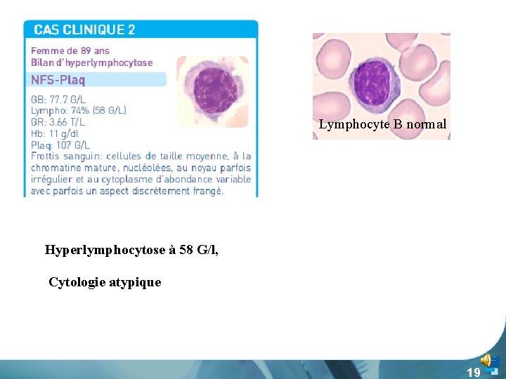 Lymphocyte B normal Hyperlymphocytose à 58 G/l, Cytologie atypique 19 