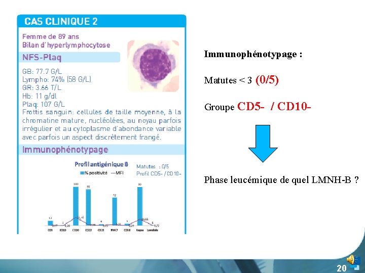 Immunophénotypage : Matutes < 3 (0/5) Groupe CD 5 - / CD 10 -