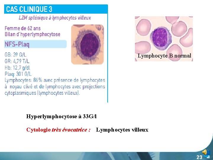 Lymphocyte B normal Hyperlymphocytose à 33 G/l Cytologie très évocatrice : Lymphocytes villeux 23