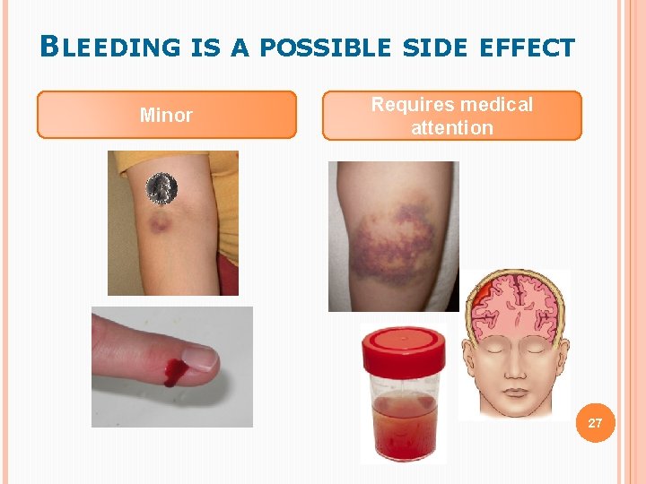 BLEEDING IS A POSSIBLE SIDE EFFECT Minor Requires medical attention 27 BLEEDING IS A POSSIBLE SIDE EFFECT Minor Requires medical attention 27