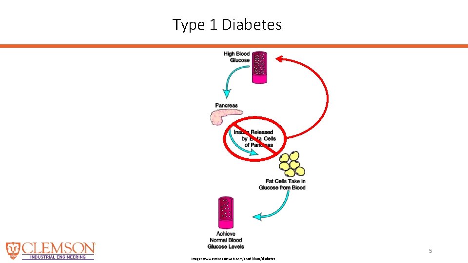 Type 1 Diabetes 5 Image: www. endocrineweb. com/conditions/diabetes 
