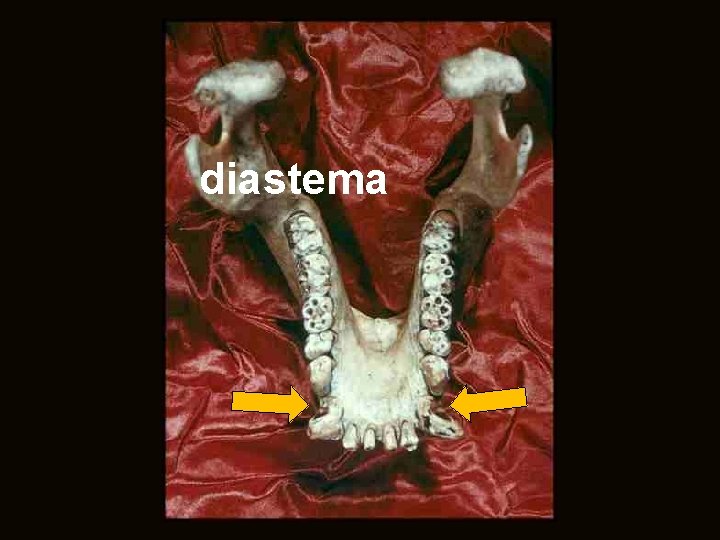 diastema 