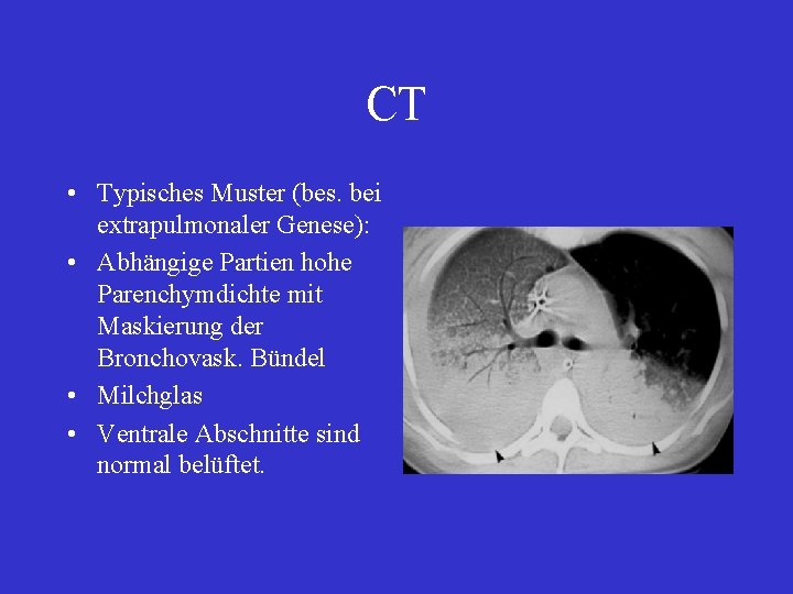 CT • Typisches Muster (bes. bei extrapulmonaler Genese): • Abhängige Partien hohe Parenchymdichte mit