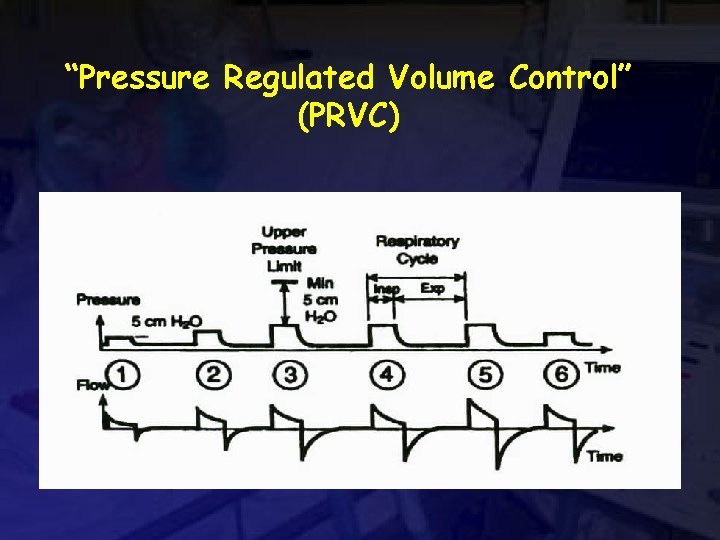 “Pressure Regulated Volume Control” (PRVC) 