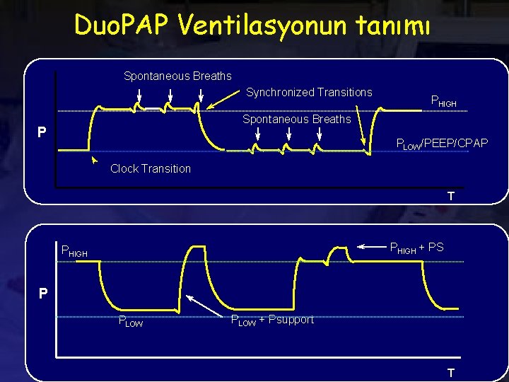 Duo. PAP Ventilasyonun tanımı Spontaneous Breaths Synchronized Transitions PHIGH Spontaneous Breaths P PLOW/PEEP/CPAP Clock