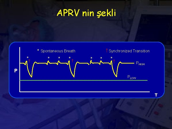 APRV nin şekli † Synchronized Transition * Spontaneous Breath * † * * *