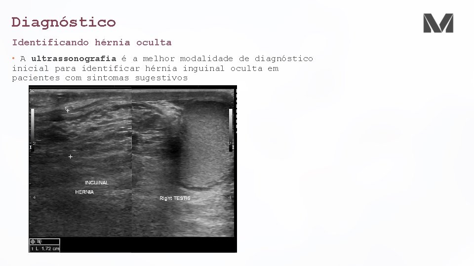Diagnóstico Identificando hérnia oculta • A ultrassonografia é a melhor modalidade de diagnóstico inicial Diagnóstico Identificando hérnia oculta • A ultrassonografia é a melhor modalidade de diagnóstico inicial