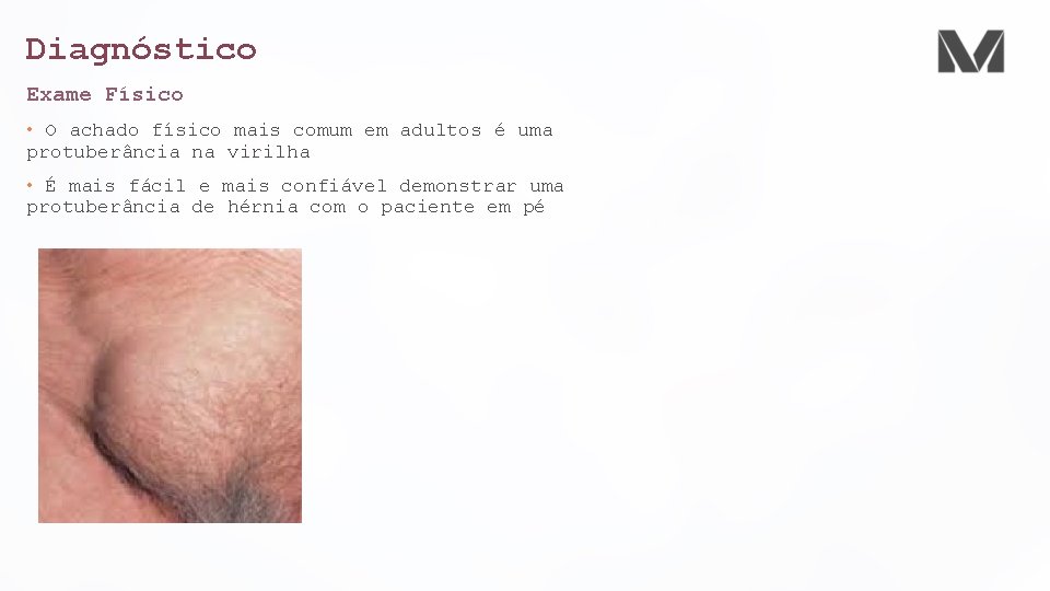 Diagnóstico Exame Físico • O achado físico mais comum em adultos é uma protuberância Diagnóstico Exame Físico • O achado físico mais comum em adultos é uma protuberância