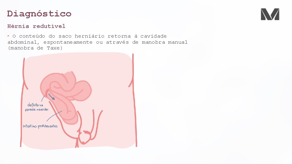 Diagnóstico Hérnia redutível • O conteúdo do saco herniário retorna à cavidade abdominal, espontaneamente Diagnóstico Hérnia redutível • O conteúdo do saco herniário retorna à cavidade abdominal, espontaneamente