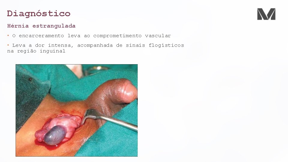 Diagnóstico Hérnia estrangulada • O encarceramento leva ao comprometimento vascular • Leva a dor Diagnóstico Hérnia estrangulada • O encarceramento leva ao comprometimento vascular • Leva a dor