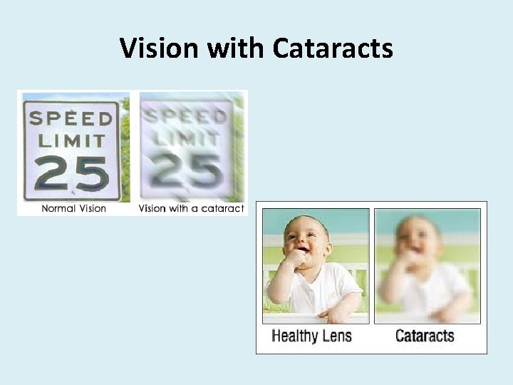 Vision with Cataracts 