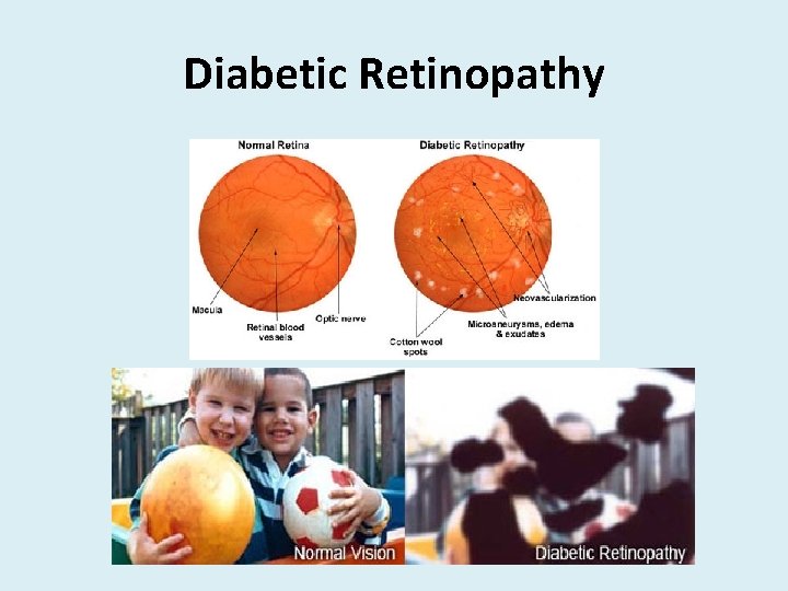 Diabetic Retinopathy 