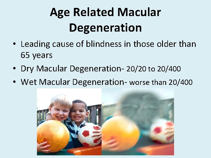 Age Related Macular Degeneration • Leading cause of blindness in those older than 65