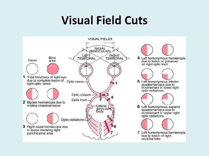 Visual Field Cuts 