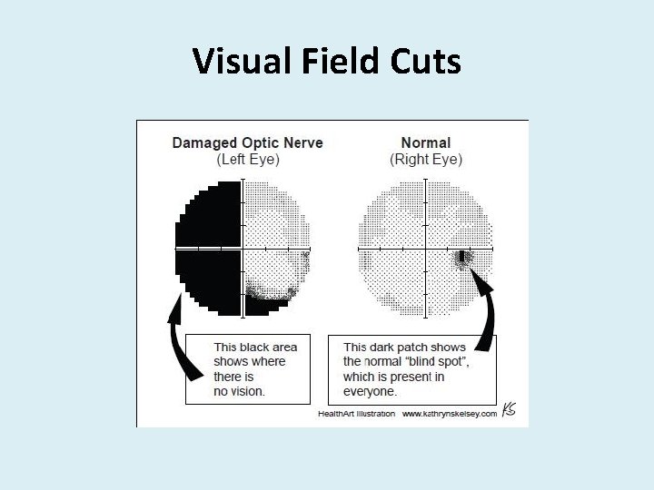 Visual Field Cuts 