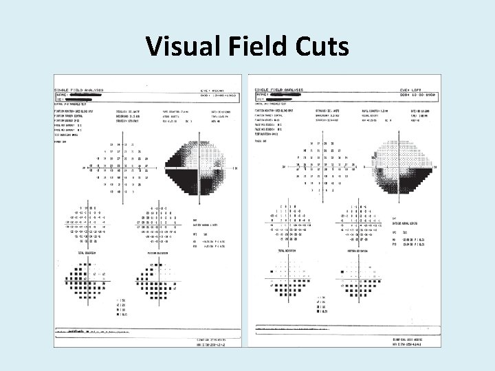 Visual Field Cuts 