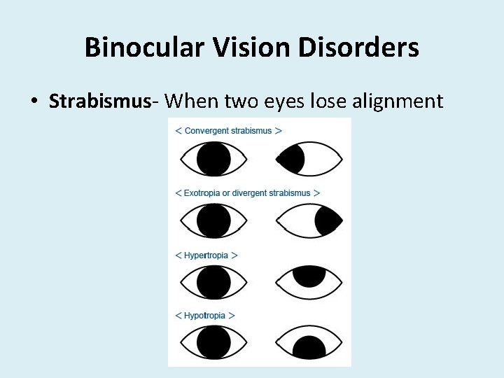 Binocular Vision Disorders • Strabismus- When two eyes lose alignment 