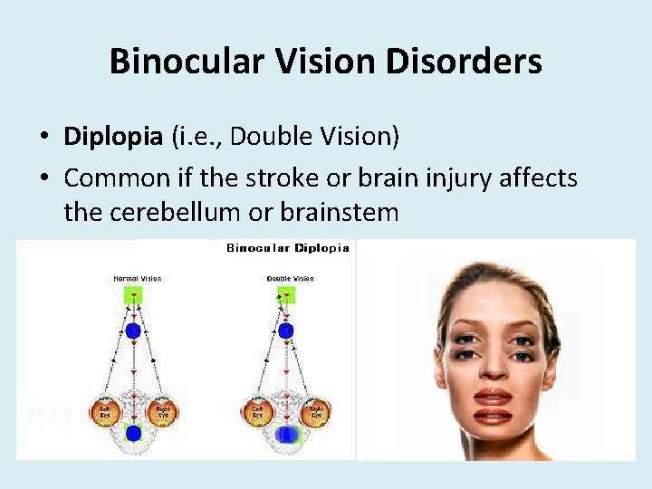 Binocular Vision Disorders • Diplopia (i. e. , Double Vision) • Common if the