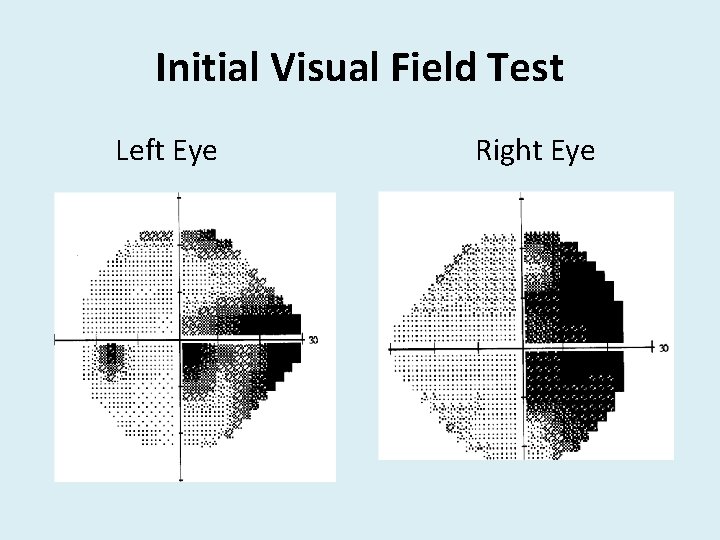 Initial Visual Field Test Left Eye Right Eye 