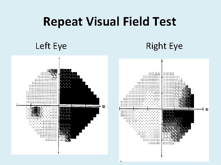 Repeat Visual Field Test Left Eye Right Eye 